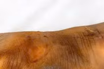 Nguy cơ bùng phát bệnh Whitmore nguy cơ tử vong 40-60% sau mưa lũ