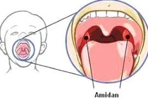 Bấm huyệt tay, chân trị viêm amiđan cấp, mạn tính