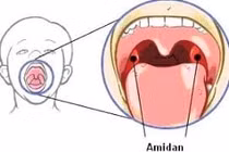 Bấm huyệt tay, chân trị viêm amiđan cấp, mạn tính