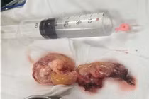 Khối u quái ác quay lại sau 13 năm 'ngủ yên'