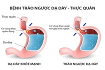 Bác sĩ mách cách chữa bệnh trào ngược dạ dày - thực quản hiệu quả