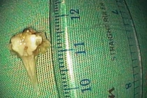 Ho khạc ra máu người đàn ông bị mảnh xương cá đâm suýt thủng phế quản