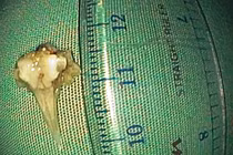 Ho khạc ra máu người đàn ông bị mảnh xương cá đâm suýt thủng phế quản