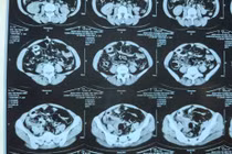 Cảnh giác tắc ruột do biến chứng đa túi thừa ruột non ở người trẻ