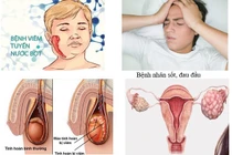 Lây quai bị từ con gái, người đàn ông ở Hà Tĩnh có nguy cơ vô sinh