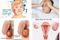 Lây quai bị từ con gái, người đàn ông ở Hà Tĩnh có nguy cơ vô sinh