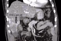 Đau hạ sườn 1 ngày, người đàn ông vỡ u gan nguy kịch
