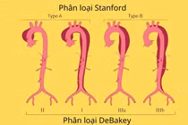 Cứu người đàn ông 47 tuổi bị lóc tách động mạch chủ