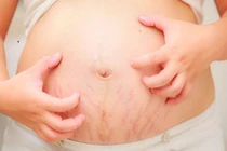 Bác sĩ mách cách xử lý ngứa ở phụ nữ mang thai an toàn