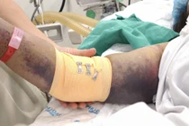 Nhiều ca sốc sốt xuất huyết dengue nguy kịch nhập viện