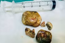 Tiểu buốt, đau tức mạn sườn do sỏi bàng quang kích thước lớn