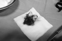 Lấy u buồng trứng xoắn chứa xương tóc, bảo toàn thai nhi 