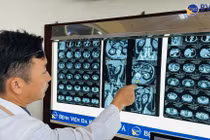 Đau âm ỉ vùng lưng không ngờ sỏi san hô kích thước lớn chiếm 2 quả thận