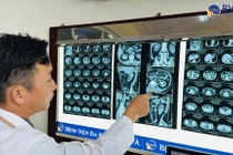 Đau âm ỉ vùng lưng không ngờ sỏi san hô kích thước lớn chiếm 2 quả thận