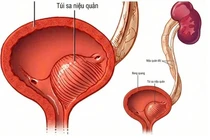 Nội soi không vết mổ giải cứu bé trai 6 tháng tuổi nhiễm trùng tiểu nặng