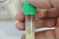 Viêm tụy cấp do không tuân thủ điều trị đái tháo đường