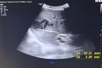 Lấy tăm ngậm xuyên vào gan cho người bệnh 65 tuổi