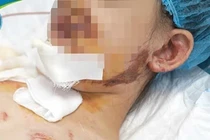 Nhiều trẻ nguy kịch vì tai nạn thương tích ngày hè