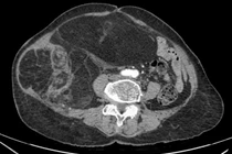 Bụng to nhanh, người phụ nữ 76 tuổi không ngờ mang u ác nặng 4 kg