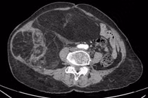 Bụng to nhanh, người phụ nữ 76 tuổi không ngờ mang u ác nặng 4 kg
