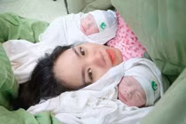 Ca sinh đôi chung bánh rau, buồng ối có một bé “đẻ bọc điều”