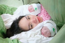 Ca sinh đôi chung bánh rau, buồng ối có một bé “đẻ bọc điều”