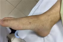 Sốt cao tự truyền dịch, người bệnh nguy kịch vì viêm màng não mô cầu