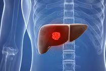 Địa chỉ vàng: Bệnh viện điều trị u máu gan