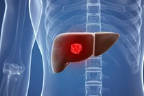 Địa chỉ vàng: Bệnh viện điều trị u máu gan