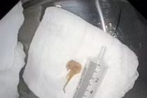 Khó thở kéo dài không ngờ xương cá lóc trú trong đường thở 2 tháng