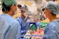 Đột ngột đau đầu, người phụ nữ khỏe mạnh lơ mơ vì vỡ túi phình động mạch não