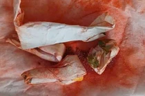 Bôi thuốc cam chữa sẩn ngứa bé 5 tuổi ngộ độc chì