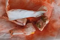 Bôi thuốc cam chữa sẩn ngứa bé 5 tuổi ngộ độc chì