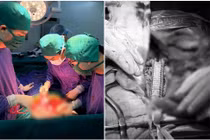 Một lần mổ thay cả động mạch chủ chậu, lấy sỏi ống mật chủ ở người ung thư