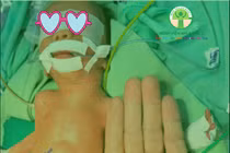 Giành lại sự sống cho trẻ sinh non nặng gần 1 kg bị viêm ruột hoại tử