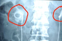 Để sonde JJ quá 2 năm, sỏi bám vòng quanh gây thận ứ nước, nguy cơ ngừng tim