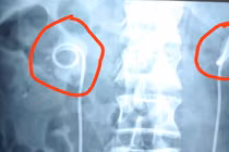 Để sonde JJ quá 2 năm, sỏi bám vòng quanh gây thận ứ nước, nguy cơ ngừng tim