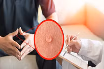 Bác sĩ mách cách phát hiện bệnh sùi mào gà 