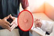 Bác sĩ mách cách phát hiện bệnh sùi mào gà 