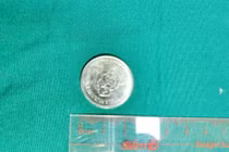 Cuộc chạy đua sinh tử cứu em bé nuốt đồng xu