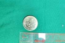 Cuộc chạy đua sinh tử cứu em bé nuốt đồng xu