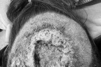 Áp xe hoại tử vùng da đầu ở trẻ 9 tuổi do nấm Kerion