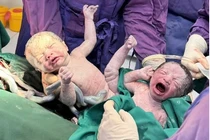 Cứu sản phụ và 2 thai nhi IVF tiền sản giật nặng đẻ non