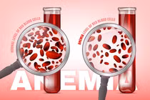 70% bệnh nhân ung thư máu tin vào quan điểm sai lầm 