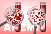 70% bệnh nhân ung thư máu tin vào quan điểm sai lầm 