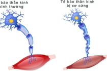 Xơ cột bên teo cơ, khi cơ thể dần “quên” cách vận động