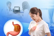 Cẩn thận ợ nóng hay ợ chua gây viêm loét, hẹp thực quản, ung thư