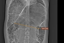 Nam sinh 18 tuổi cắt hơn nửa mét ruột do xoắn đại tràng sigma