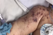 Một bệnh nhi tử vong do viêm não mô cầu nhóm B, có nên đổ xô đi tiêm phòng?