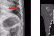 Ho ra máu đỏ tươi, không ngờ trẻ 3 tuổi nuốt đoạn kẽm nhung dài 2cm
